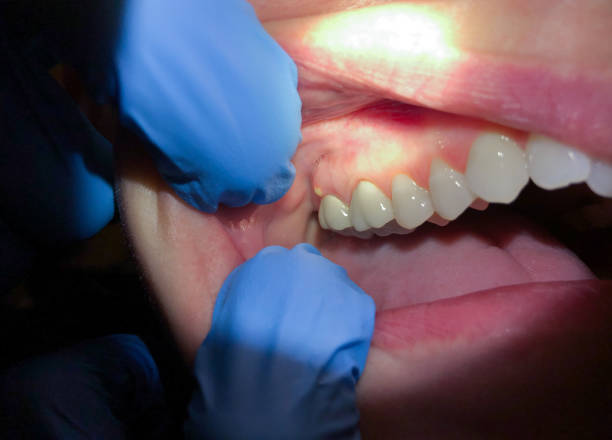 Best Chipped Tooth Repair Near Me  in Abilene, TX